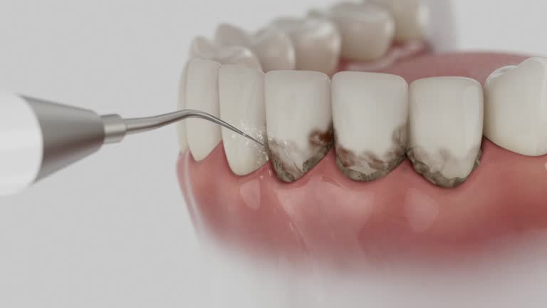 Trusted Wisdom Tooth Removal service in Wallace, FL - Dentist Open Now